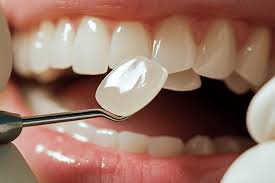 About Dental Veneers