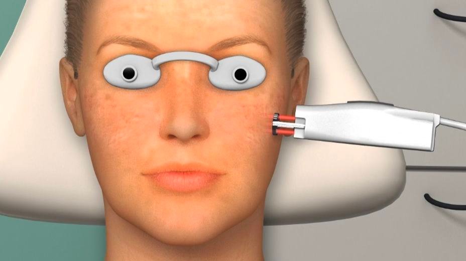 Laser Skin Resurfacing Boynton Beach